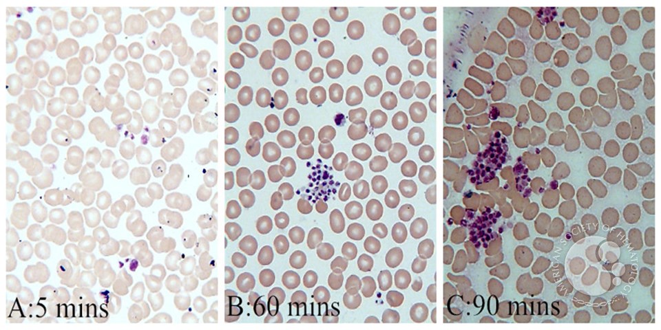 platelet clumps significantly with time gone