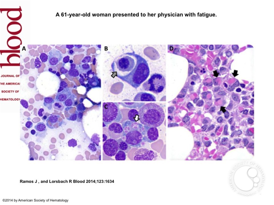 Hemophagocytosis by neoplastic plasma cells in multiple myeloma
