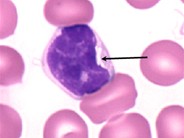 Crystalline Inclusions in Malignant Lymphocytes - 1.