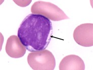 Crystalline Inclusions in Malignant Lymphocytes - 3.