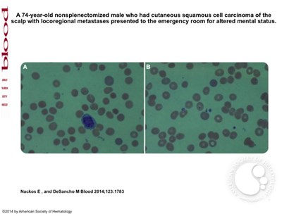 Anemia and thrombocytopenia: diagnosis from the blood smear