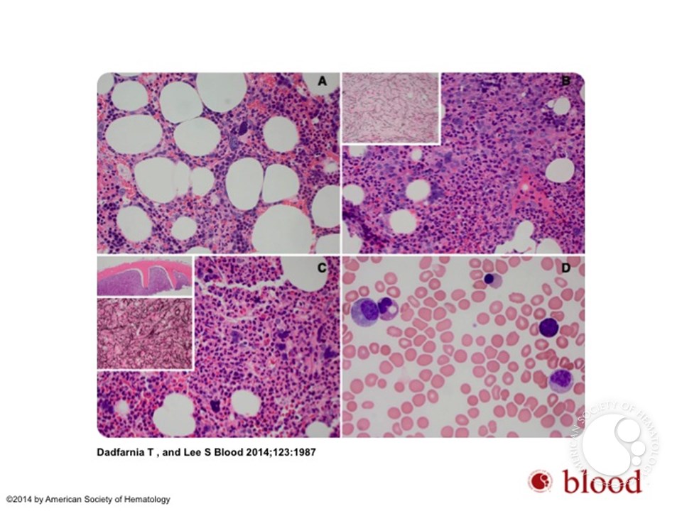 Progression of romiplostim myelofibrosis to myeloproliferative neoplasm