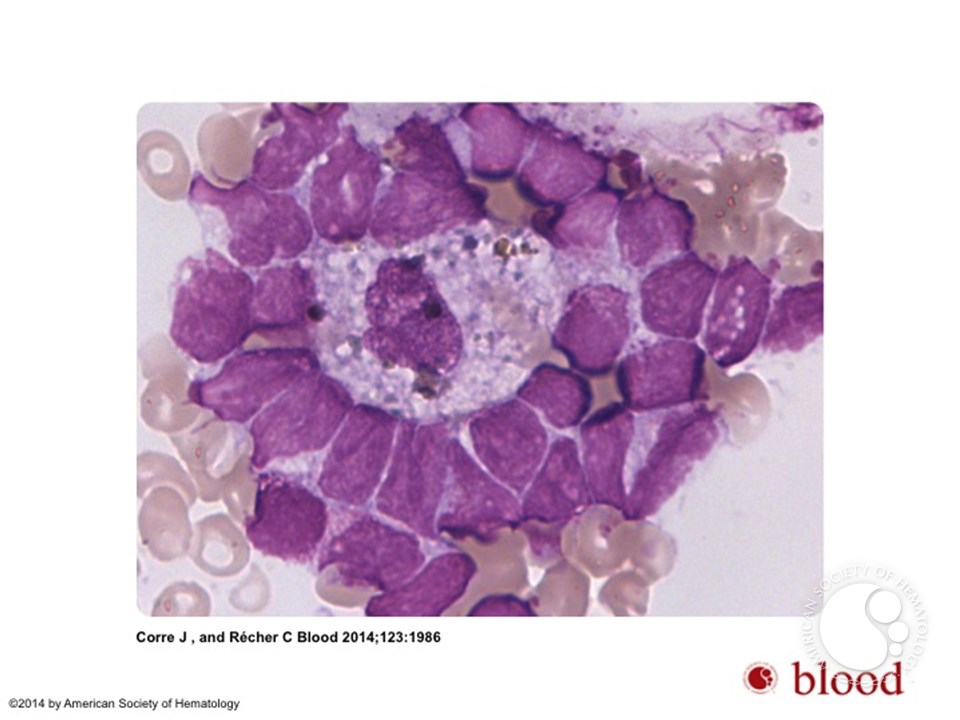 Blastic island in acute myeloid leukemia
