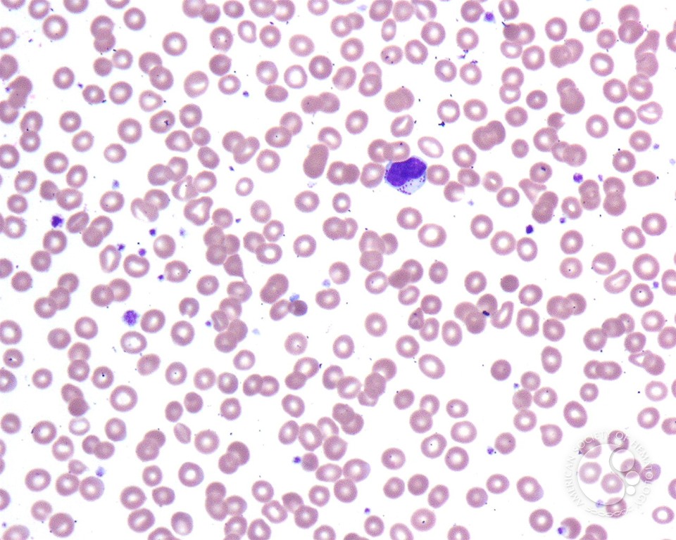 NK Cell Lymphocytosis - 6.