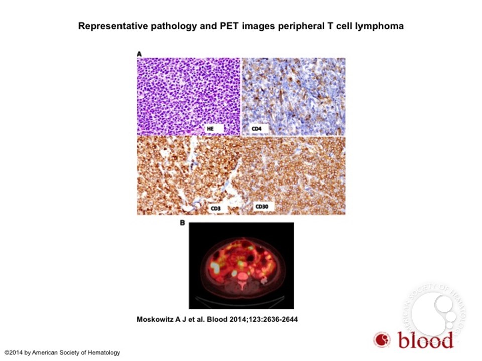 Peripheral T-cell lymphomas