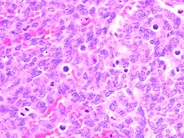 Undifferentiated Metastatic Neuroblastoma - 10.