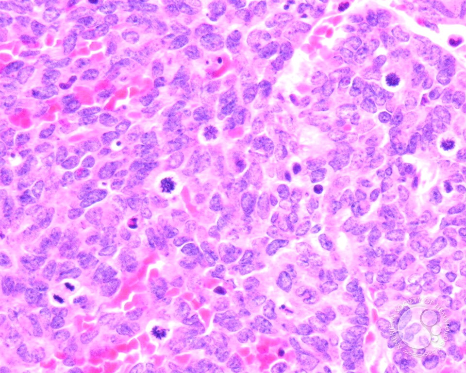 Undifferentiated Metastatic Neuroblastoma - 10.