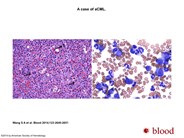 Atypical chronic myeloid leukemia