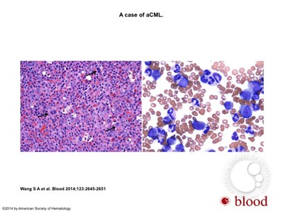 Atypical chronic myeloid leukemia