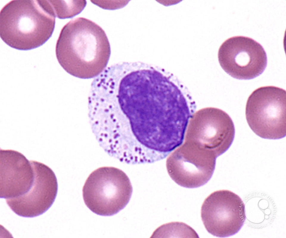 Large Granular Lymphocyte - 1.