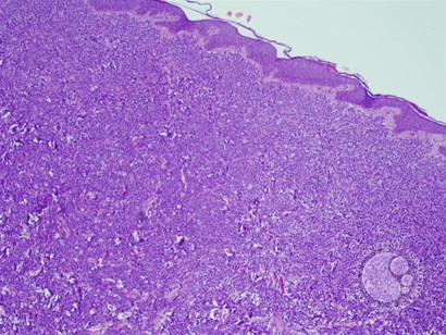 Myeloid Sarcoma -1