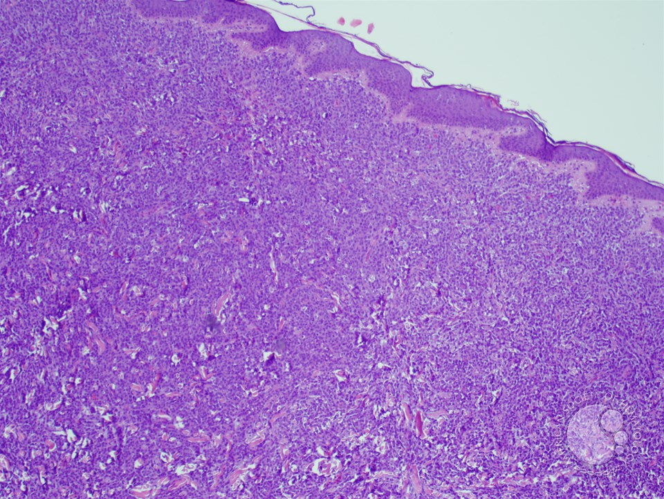 Myeloid Sarcoma -1