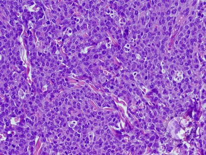 Myeloid Sarcoma-2