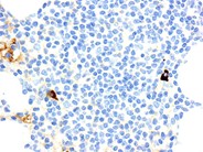 Rituximab-Associated Marrow T-cell Hyperplasia - 9.