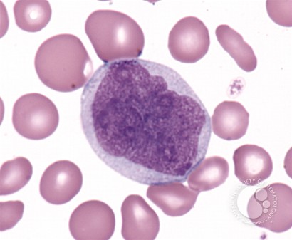 Chronic Myelomonocytic Leukemia - 2.