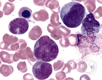 Chronic Myelomonocytic Leukemia - 6.
