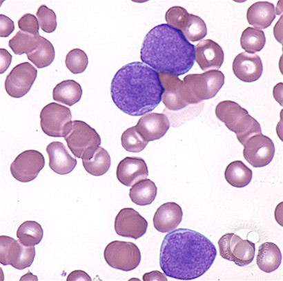 Acute Myelomonocytic Leukemia - 2.