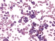 Precursor B-Cell ALL - 2.
