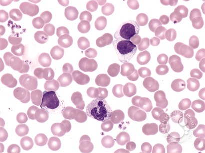 Large Granular Lymphocyte Leukemia - 1.