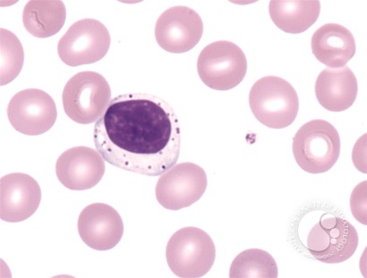Large Granular Lymphocyte Leukemia - 2.