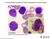 Acute basophilic leukemia