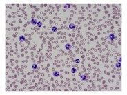 Chronic Neutrophilic Leukemia