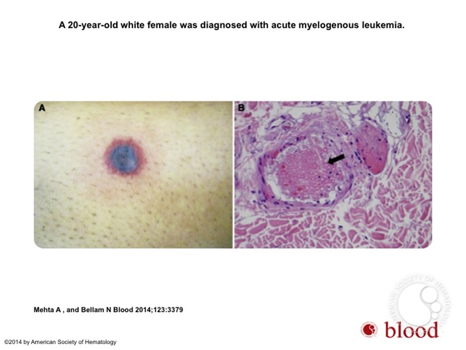 Disseminated fusariosis during acute myelogenous leukemia induction treatment