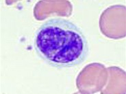 Sézary Syndrome - 3.