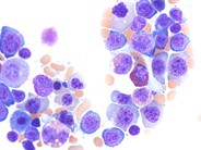 Megaloblastic Anemia Secondary to Pyrimethamine - 2.