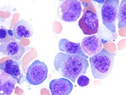 Megaloblastic Anemia Secondary to Pyrimethamine - 3.