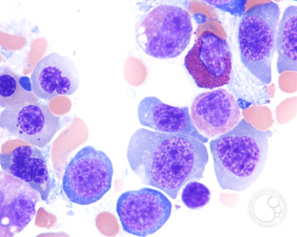 Megaloblastic Anemia Secondary to Pyrimethamine - 3.