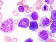 Megaloblastic Anemia Secondary to Pyrimethamine - 4.