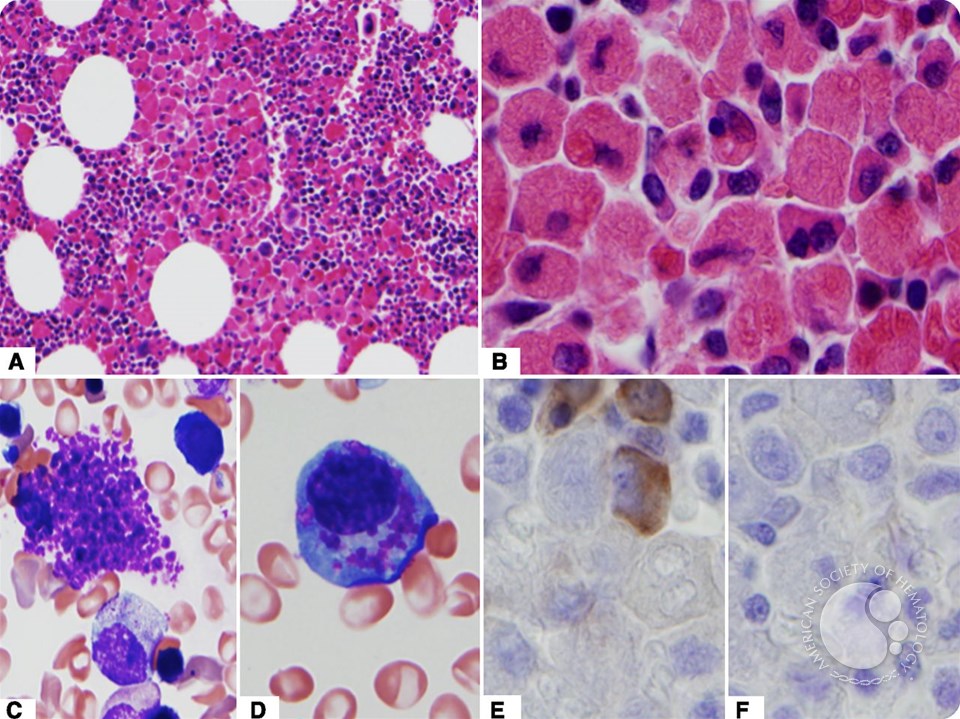 Crystal-storing histiocytosis with IgD kappa–associated plasma cell neoplasm