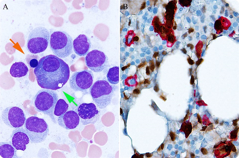 Chance identification of synchronous hairy cell leukemia and plasma cell myeloma in a potential HSC donor