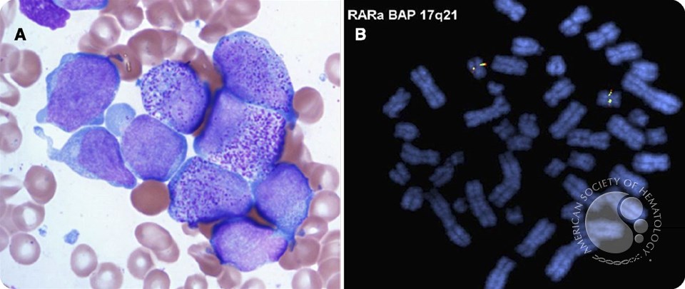 Acute myeloid leukemia pretreated with filgastrim mimicking acute promyelocytic leukemia