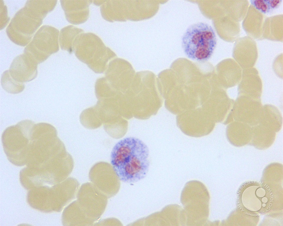 Leukocyte Alkaline Phosphatase Scoring - 3.