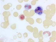 Leukocyte Alkaline Phosphatase Scoring - 6.