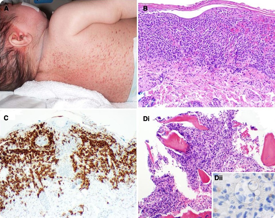Langerhans cell histiocytosis with atypical histiocytic marrow infiltration