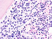 Neuroblastoma Ganglion Cell Differentiation Following Chemotherapy - 4.