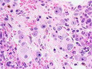 Neuroblastoma Ganglion Cell Differentiation Following Chemotherapy - 8.