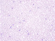 Platelet satellitism due to EDTA  Anticoagulant - 1.