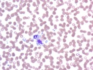 Platelet satellitism due to EDTA  Anticoagulant - 2.