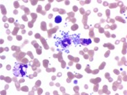 Platelet satellitism due to EDTA  Anticoagulant - 3.