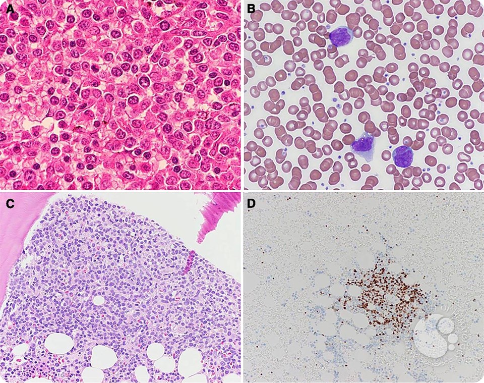 Spontaneous splenic rupture in mantle cell lymphoma with leukemic variant