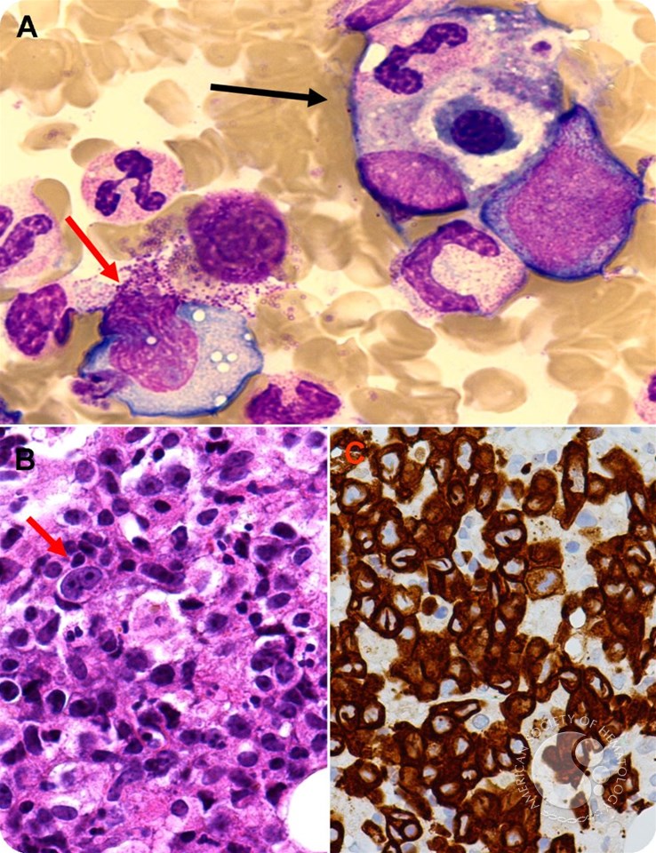 Hemophagocytosis due to bone marrow ALCL, ALK–