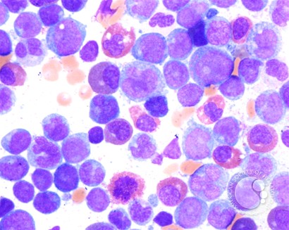 Chemotherapy-Related AML, M4e - 5.