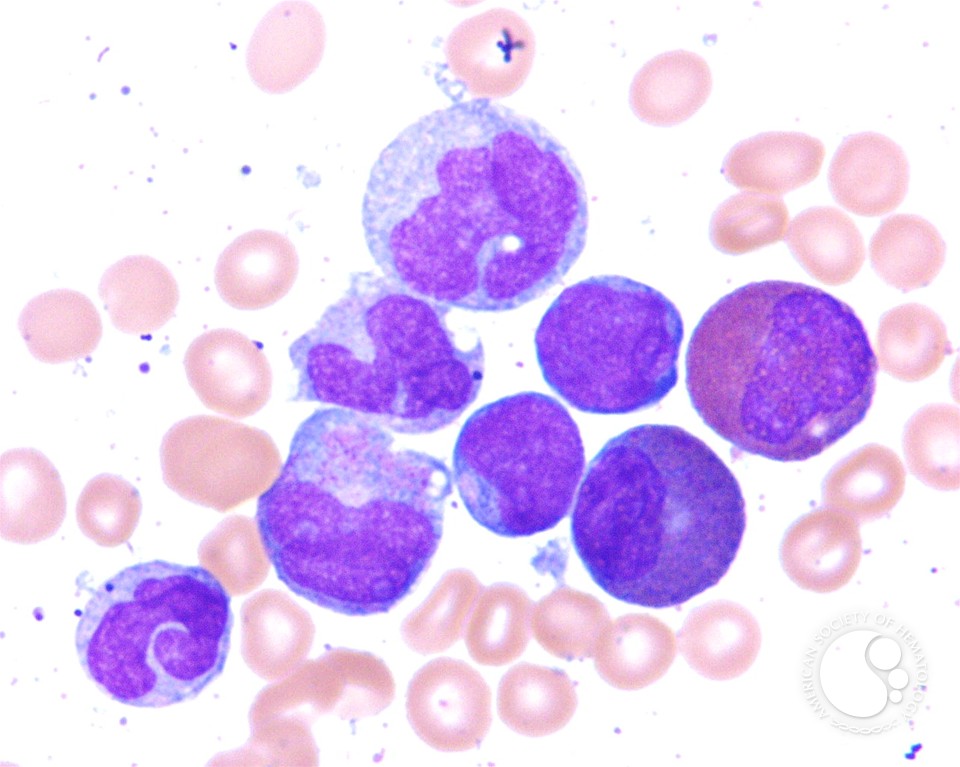 Chemotherapy-Related AML, M4e - 6.