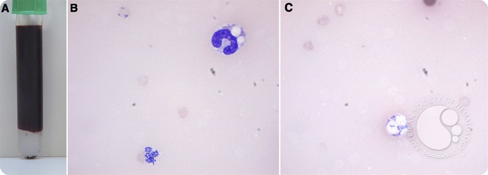 Massive hemolysis and erythrophagocytosis in severe sepsis