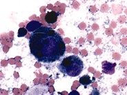 Metastatic Melanoma - 1.