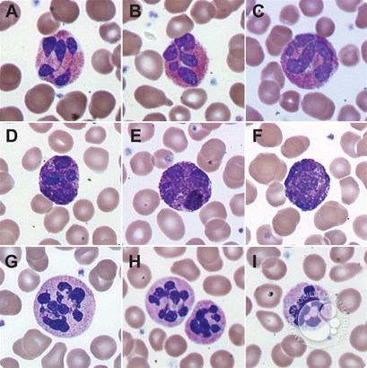 Nuclear hypersegmentation of neutrophils, eosinophils, and basophils due to hydroxycarbamide (hydroxyurea)